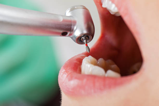Best Knocked-Out Tooth (Avulsed Tooth) Treatment in Roessleville, NY